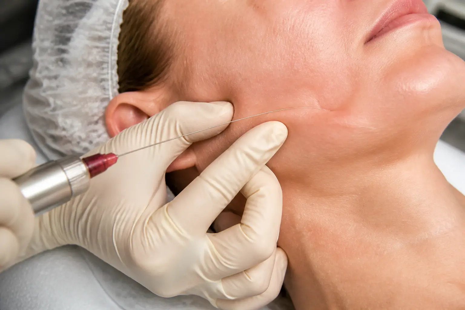 Endolifting en clinique : fibre laser sous la peau le long de la mâchoire, mains du praticien, visage partiel du patient allongé